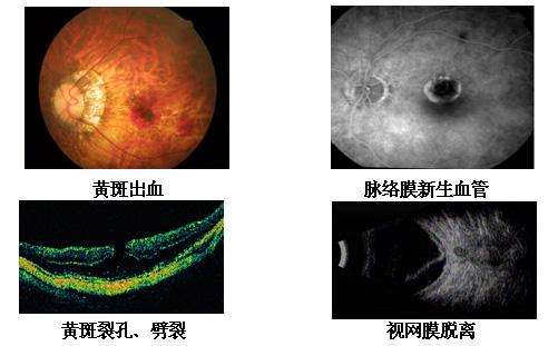高度近视如何医治.jpg 高度近视如何医治.jpg