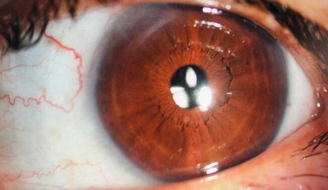 近日,白内障医治“新招”——区域折射多焦晶体落户台州五官科医院,罗阿姨也成了新技术的受益者。1.jpg 近日,白内障医治“新招”——区域折射多焦晶体落户台州五官科医院,罗阿姨也成了新技术的受益者。1.jpg