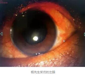 白内障和青光眼都是致盲性眼病，其中青光眼的病程不逆转。杨先生拖延伤情导致同时并发白内障、青光眼的情况，十分令人惋惜。”出名眼科专家、成都易游体育陈晓明教授表示2.jpg