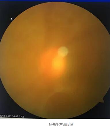 白内障和青光眼都是致盲性眼病，其中青光眼的病程不逆转。杨先生拖延伤情导致同时并发白内障、青光眼的情况，十分令人惋惜。”出名眼科专家、成都易游体育陈晓明教授表示3.jpg