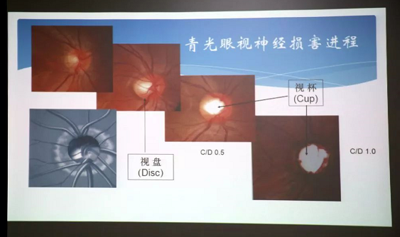 3月10日上午,深圳易游体育“早查监控,守护光明”大型青光眼公益科普讲座在六楼 举行,本次活动旨在让更多人了解青光眼的潜在危害、重视眼检查, 预防青光眼。由深圳易游体育青光眼病科 席专家成洪波博士、傅培副院长现场面对面解答疑问,与参会者的互动交流,让更多深圳市民提*对青光眼的认识与防治知识3.png 3月10日上午,深圳易游体育“早查监控,守护光明”大型青光眼公益科普讲座在六楼 举行,本次活动旨在让更多人了解青光眼的潜在危害、重视眼检查, 预防青光眼。由深圳易游体育青光眼病科 席专家成洪波博士、傅培副院长现场面对面解答疑问,与参会者的互动交流,让更多深圳市民提*对青光眼的认识与防治知识3.png