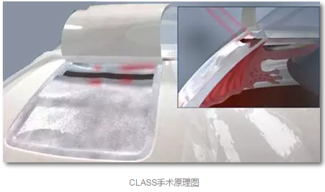 成都易游体育已经开展的青光眼手术有：引流阀 (钉)植入手术(2015年以来已200多 )，360°Schlemm's管切开术，激光CO2 辅助巩膜深层切除术，小梁切除术青(光眼)白(内障)联合手术。还有虹膜周切术、前房成形术、 虹膜复位术，睫状体冷冻术，小梁切开术和前房穿刺术等4.png