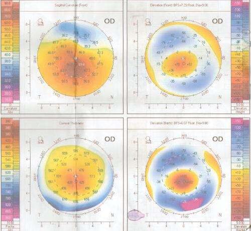 如果角膜厚度不适合角膜屈光手术,可以进行ICL晶体植入术进行 .jpg 如果角膜厚度不适合角膜屈光手术,可以进行ICL晶体植入术进行 .jpg