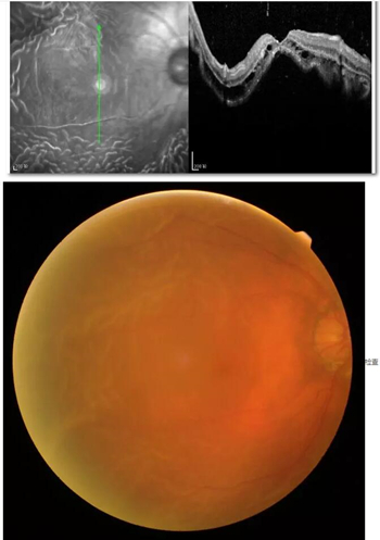 李老太在毫无征兆的情况下右眼视力下降至看不见东西。李老太家人带其至县医院就诊。医生诊断为视网膜脱离，需做玻切手术医治，而玻切手术需要动手术2次。怕疼的李老太一听就犯怵了：开刀，疼。 终，李老太的家人在多方打听后决定带李老太至宜昌易游体育找许大玲院长医治1_副本.jpg