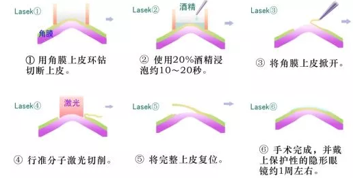 LASEK摘镜手术.png LASEK摘镜手术.png