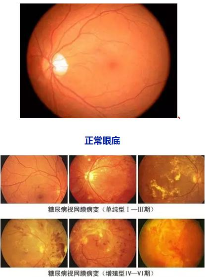 糖网病的症状和防治方式.png