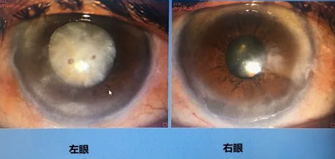 同时患 青光眼、白内障老婆婆辗转几家医院之后终于在成都易游体育顺利手术2.png 同时患 青光眼、白内障老婆婆辗转几家医院之后终于在成都易游体育顺利手术2.png