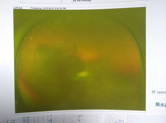 患者突然失明在厦门眼科中心就诊 原是突发玻璃体出血1.png 患者突然失明在厦门眼科中心就诊 原是突发玻璃体出血1.png