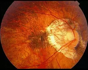 高度近视有哪些症状?2.png 高度近视有哪些症状?2.png