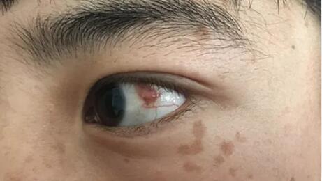 四川丹巴15岁男孩患结膜血管瘤,在成都易游体育顺利手术1.jpg 四川丹巴15岁男孩患结膜血管瘤,在成都易游体育顺利手术1.jpg