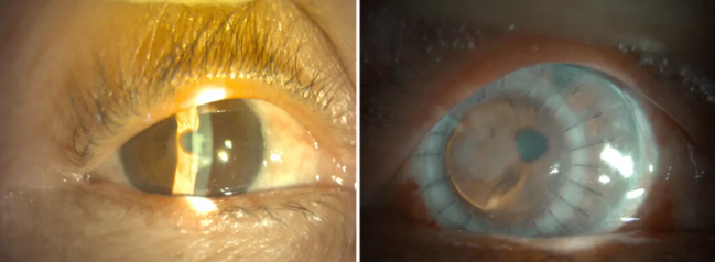 厦门眼科中心漳州眼科医院顺利完成医院首 自体转位角膜移植手术4月16日,厦门眼科中心漳州眼科医院为蓝阿姨实施自体转位穿透角膜移植术,一周过去,右眼角膜透明,眼压正常,情况一天比一天好。4月23日,蓝阿姨到院复诊,经自体转位穿透角膜移植术的右眼视力恢*到0.151.png