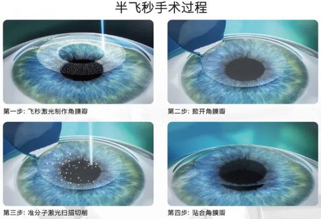 高考毕业后做近视手术,如今近视手术有了越来越高的安全性,且多样的术式可以满足不同患者的摘镜需求。3.png 高考毕业后做近视手术,如今近视手术有了越来越高的安全性,且多样的术式可以满足不同患者的摘镜需求。3.png