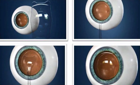 ICL晶体可以使用多久,做完手术会反*吗?易游体育医生这样说1.png ICL晶体可以使用多久,做完手术会反*吗?易游体育医生这样说1.png